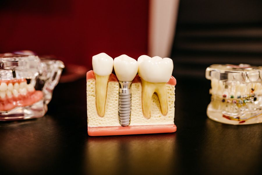 phục hình răng là gì